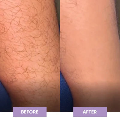 Resultado before and after WEIN